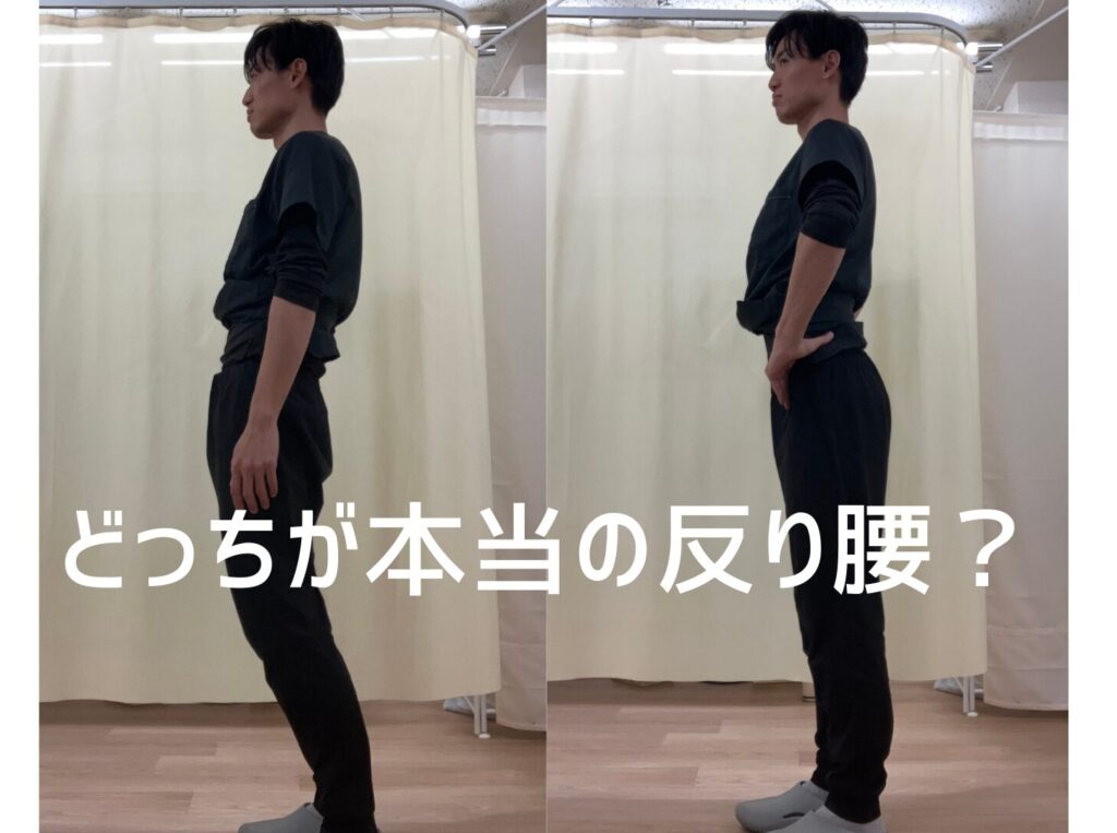 「本当の反り腰と見せかけの反り腰（スウェイバック）の比較写真」