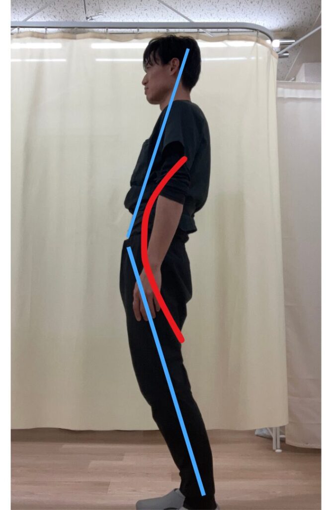 スウェイバック(軽め)
「スウェイバック軽度|一見まっすぐだが骨盤が前にズレた姿勢」