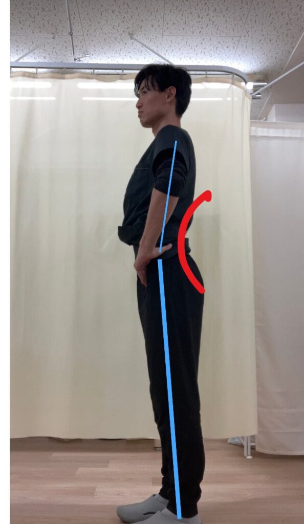 「反り腰の写真
反り腰の姿勢|腰椎前弯が強いタイプの例」