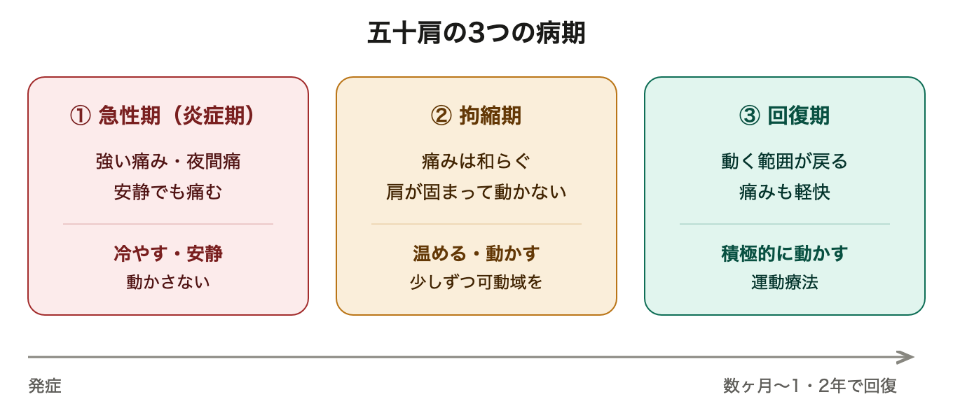 五十肩の3つの病期。急性期は冷やして安静、拘縮期は温めて動かす、回復期は積極的に動かす運動療法。