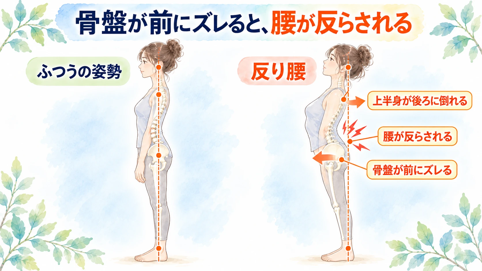 ふつうの姿勢と反り腰の比較。骨盤が前にズレ、上半身が後ろに倒れることで腰が反らされる図
